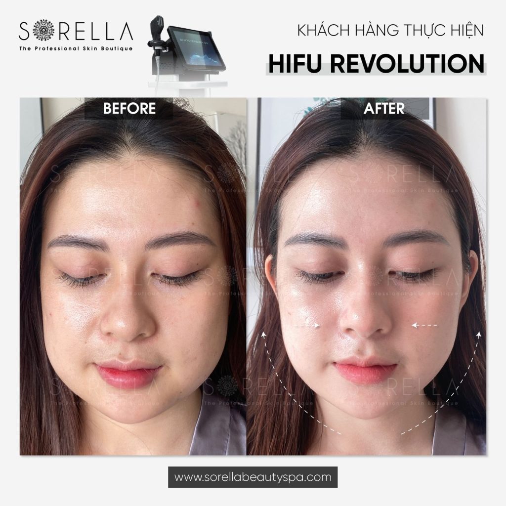 Before and after: HIFU Revolution at Sorella