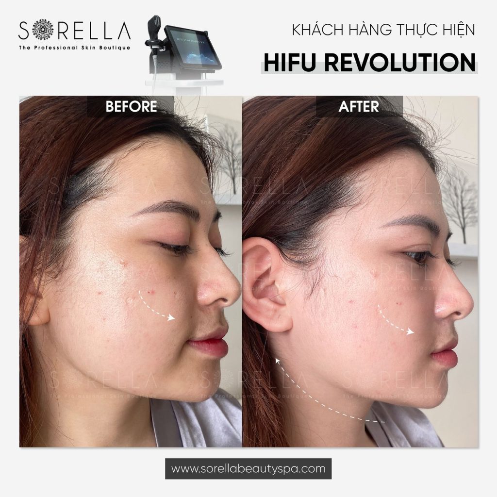 Before and after: HIFU Revolution at Sorella