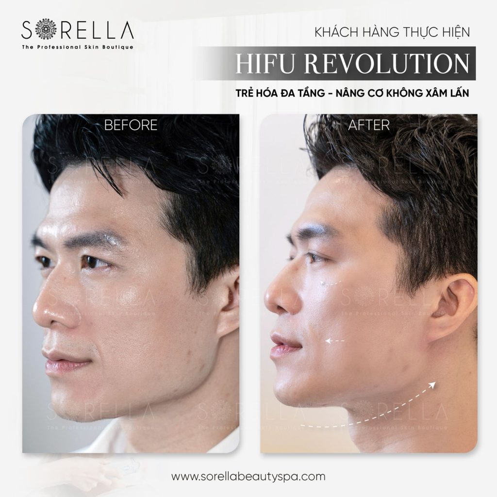 Before and after: HIFU Revolution at Sorella