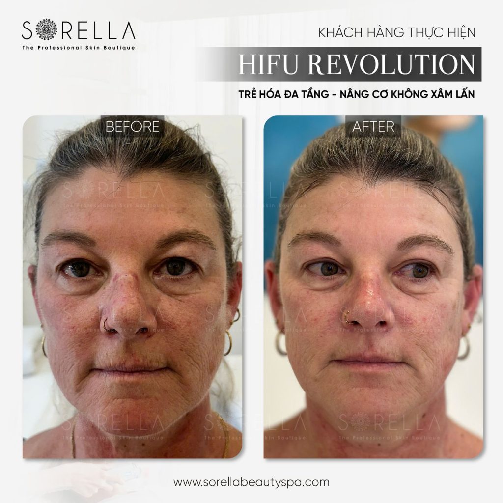 Before and after: HIFU Revolution at Sorella