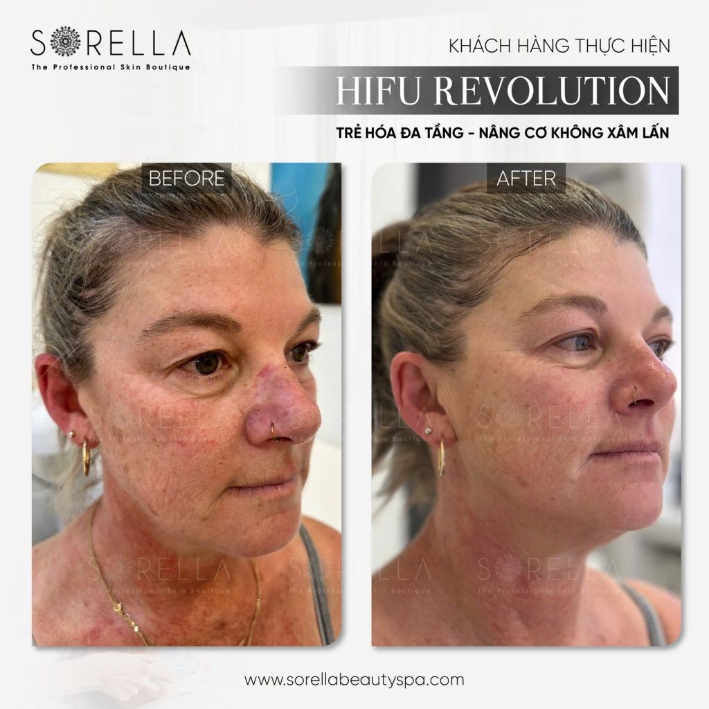 Before and after: HIFU Revolution at Sorella