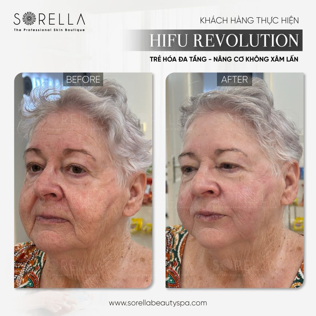 Before and after: HIFU Revolution at Sorella