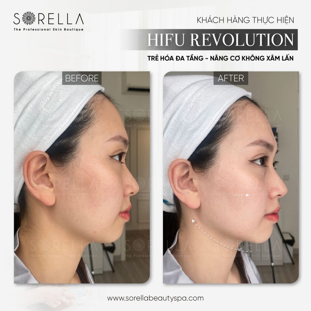 Before and after: HIFU Revolution at Sorella