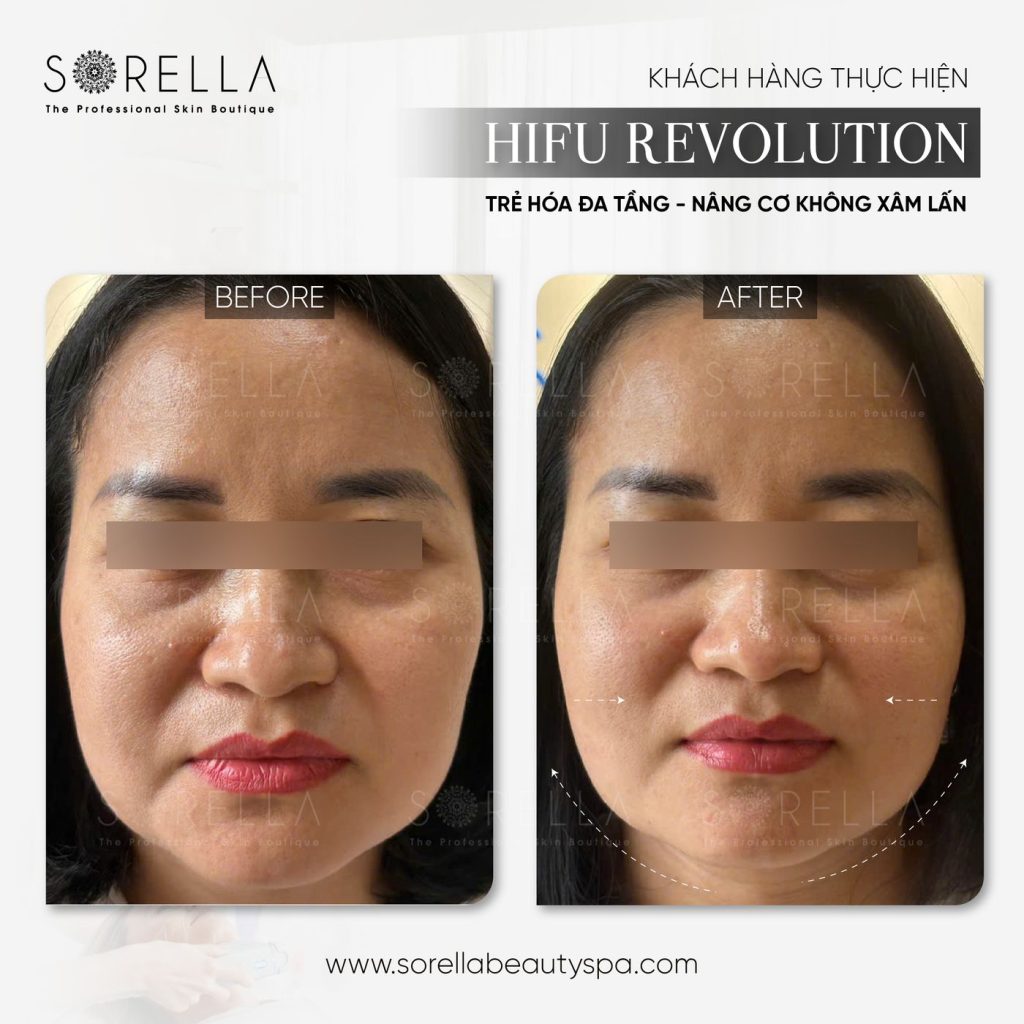 Before and after: HIFU Revolution at Sorella