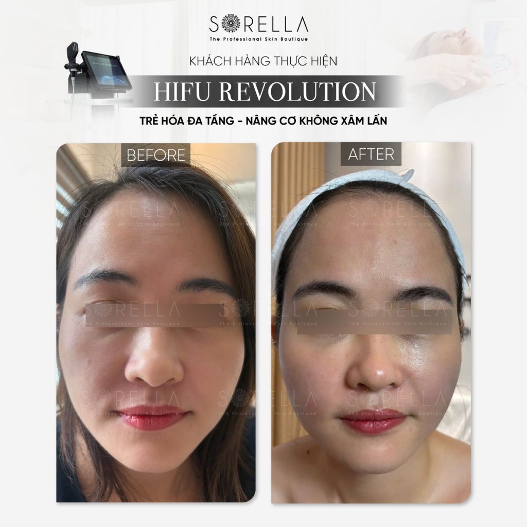 Before and after: HIFU Revolution at Sorella