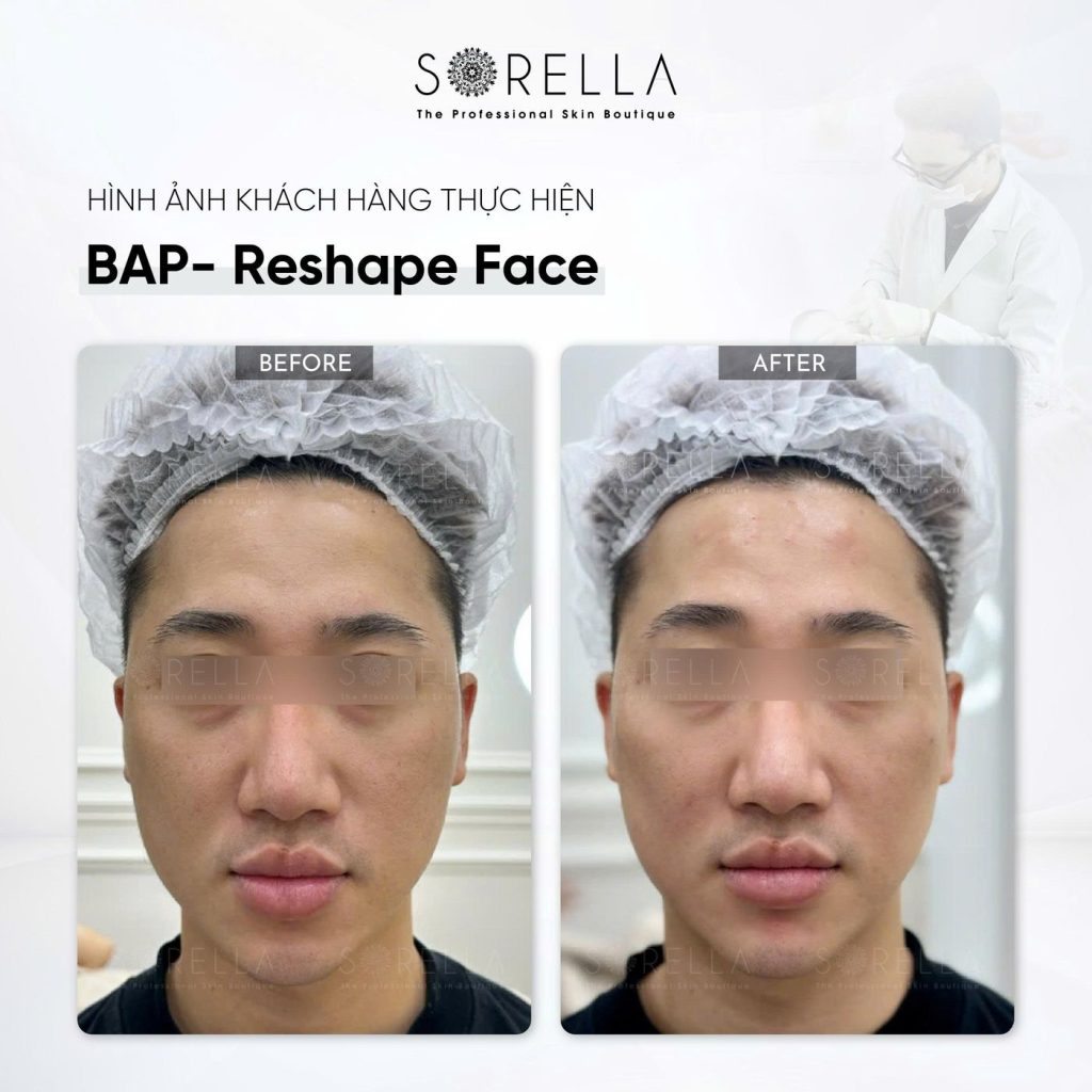 Before and after: BAP Reshape Face at Sorella