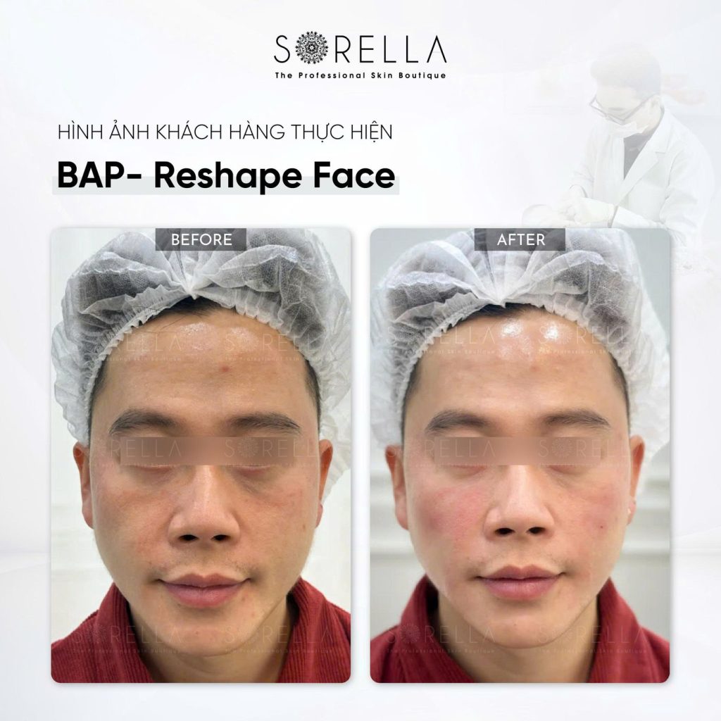 Before and after: BAP Reshape Face at Sorella