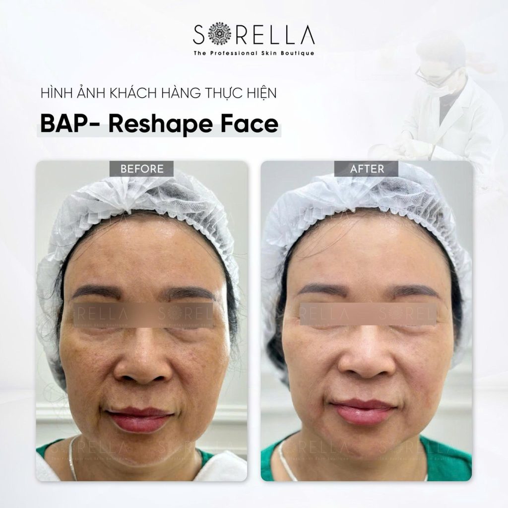 Before and after: BAP Reshape Face at Sorella