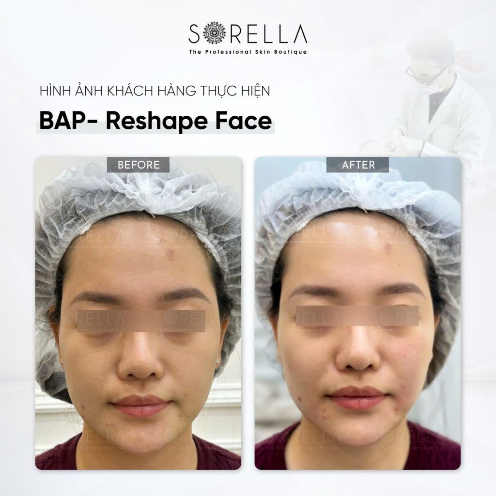 Before and after: BAP Reshape Face at Sorella