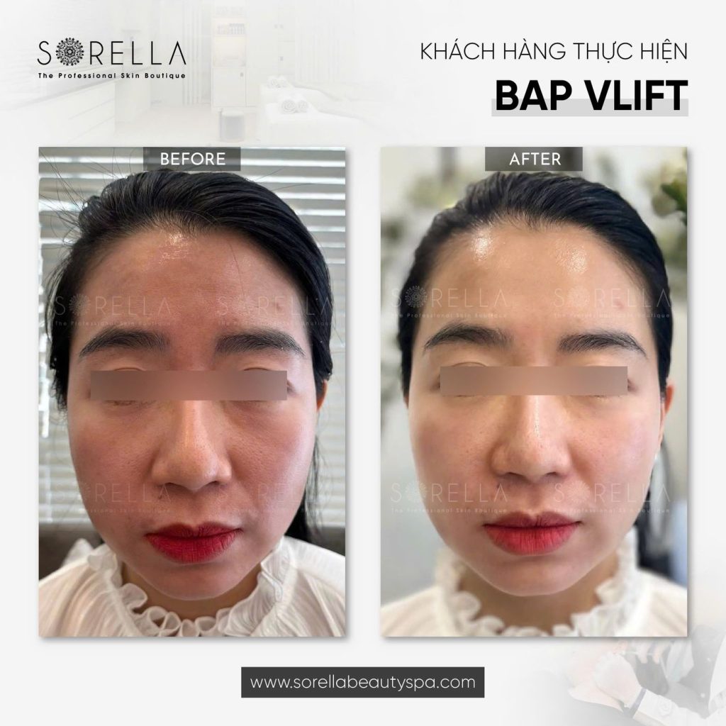 Before and after: BAP V-Lift at Sorella