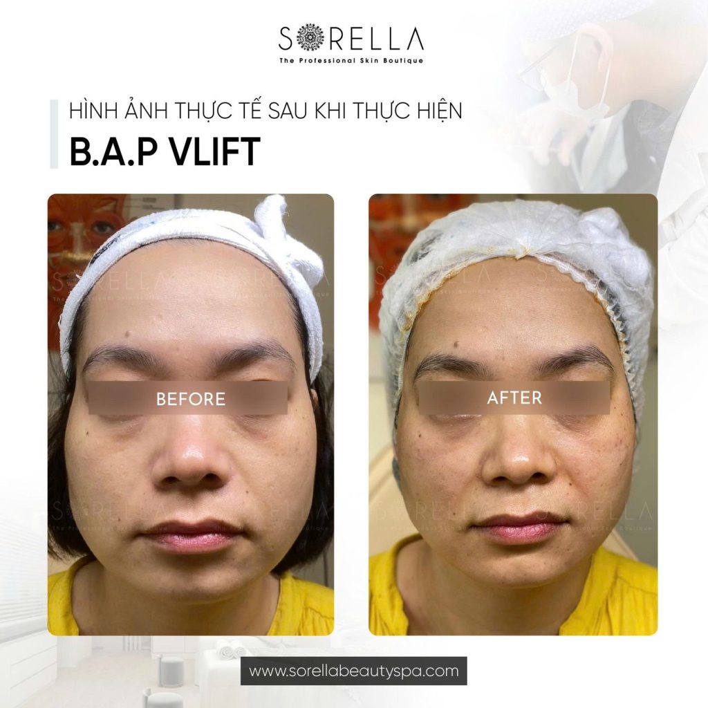 Before and after: BAP V-Lift at Sorella