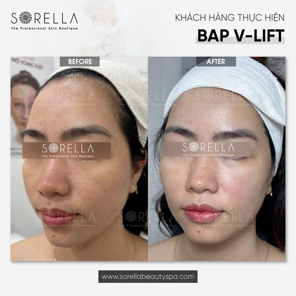 Before and after: BAP V-Lift at Sorella