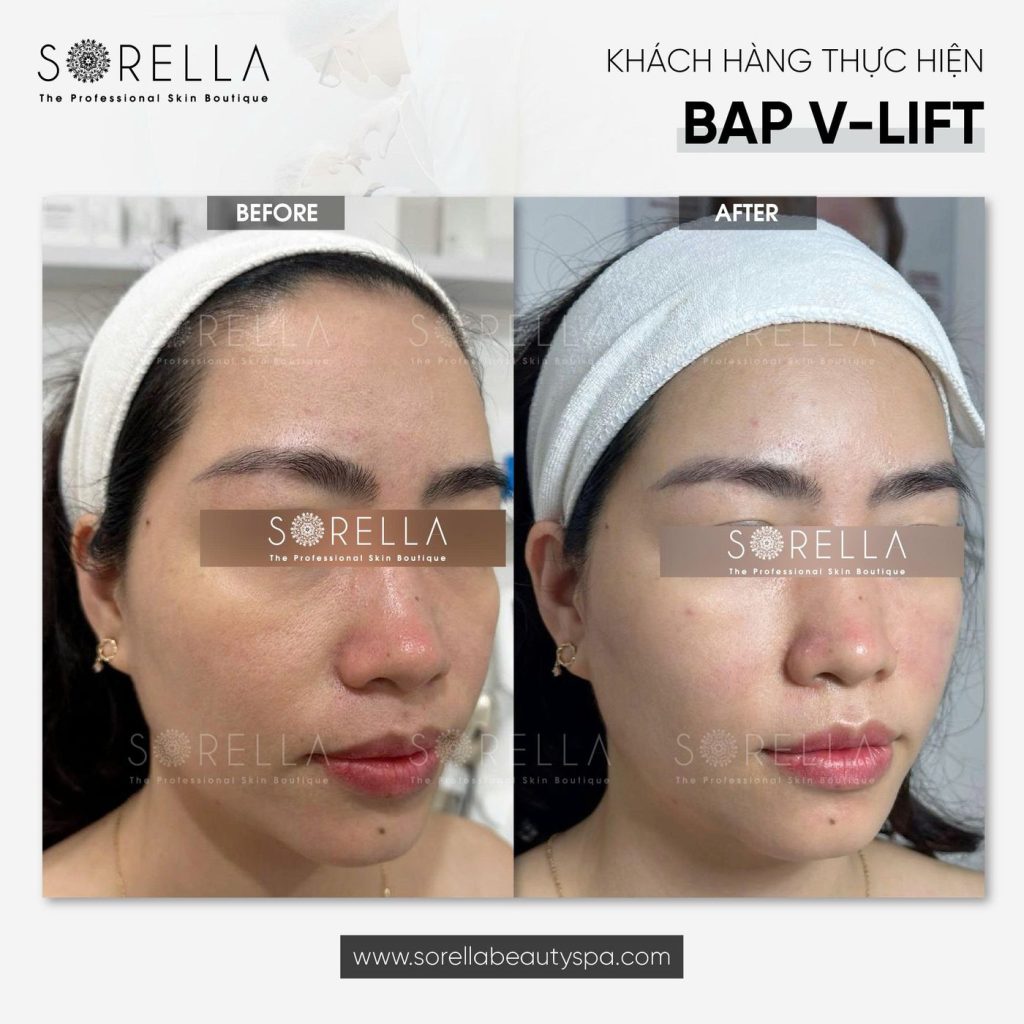 Before and after: BAP V-Lift at Sorella