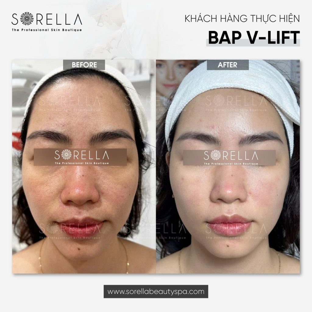 Before and after: BAP V-Lift at Sorella