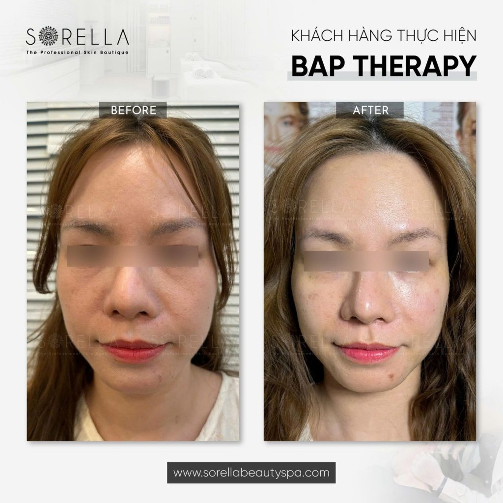 Before and after: BAP Therapy at Sorella