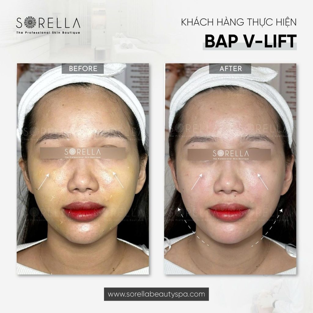 Before and after: BAP V-Lift at Sorella