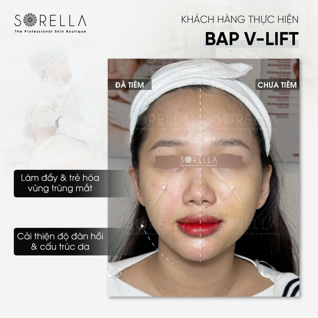 Before and after: BAP V-Lift at Sorella