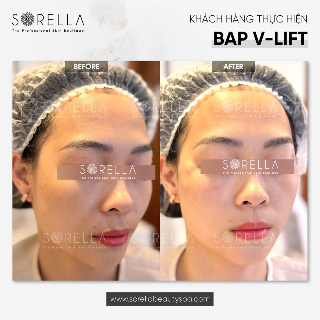 Before and after: BAP V-Lift at Sorella