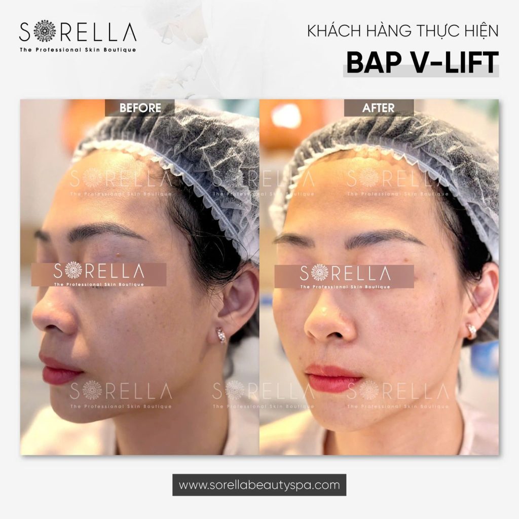 Before and after: BAP V-Lift at Sorella