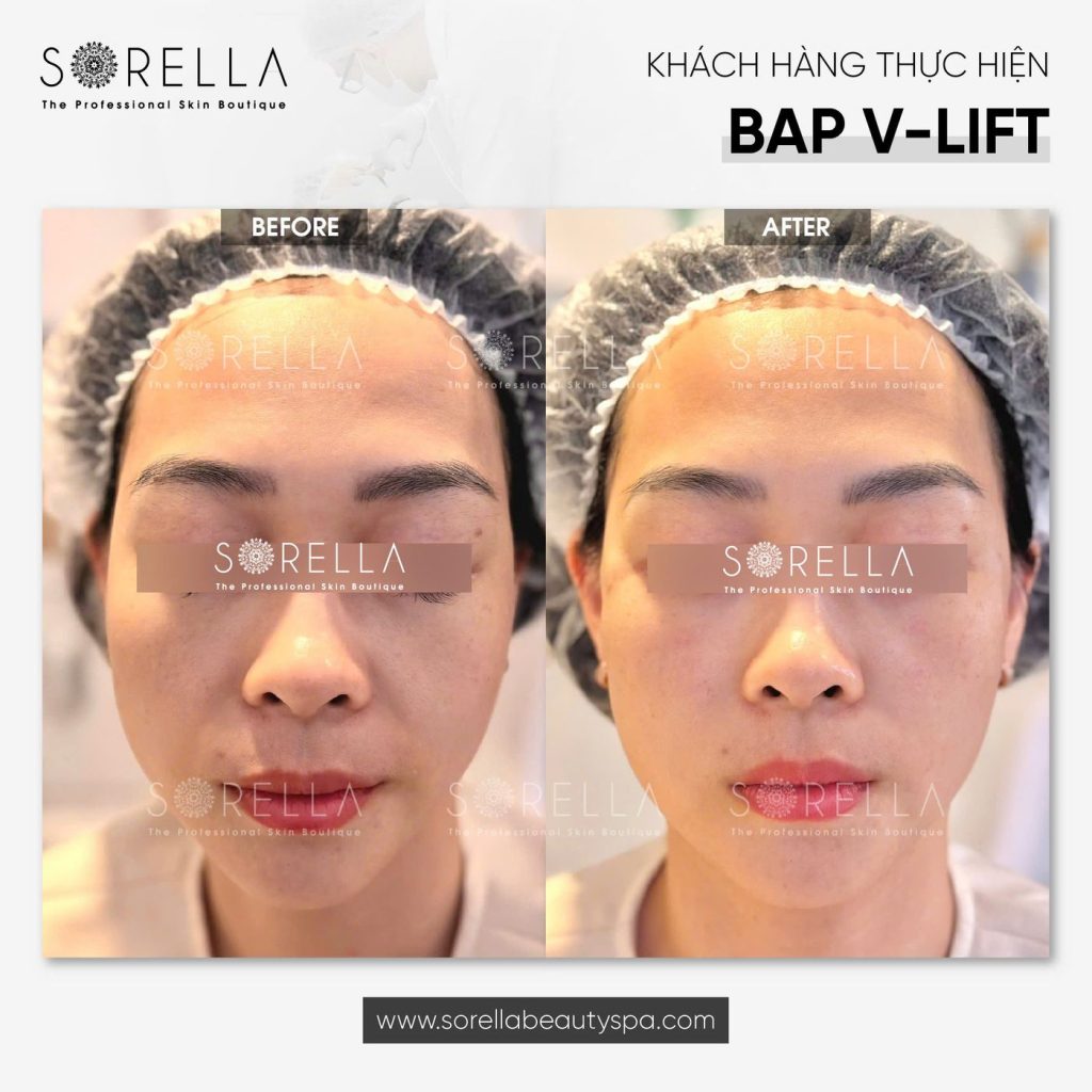 Before and after: BAP V-Lift at Sorella