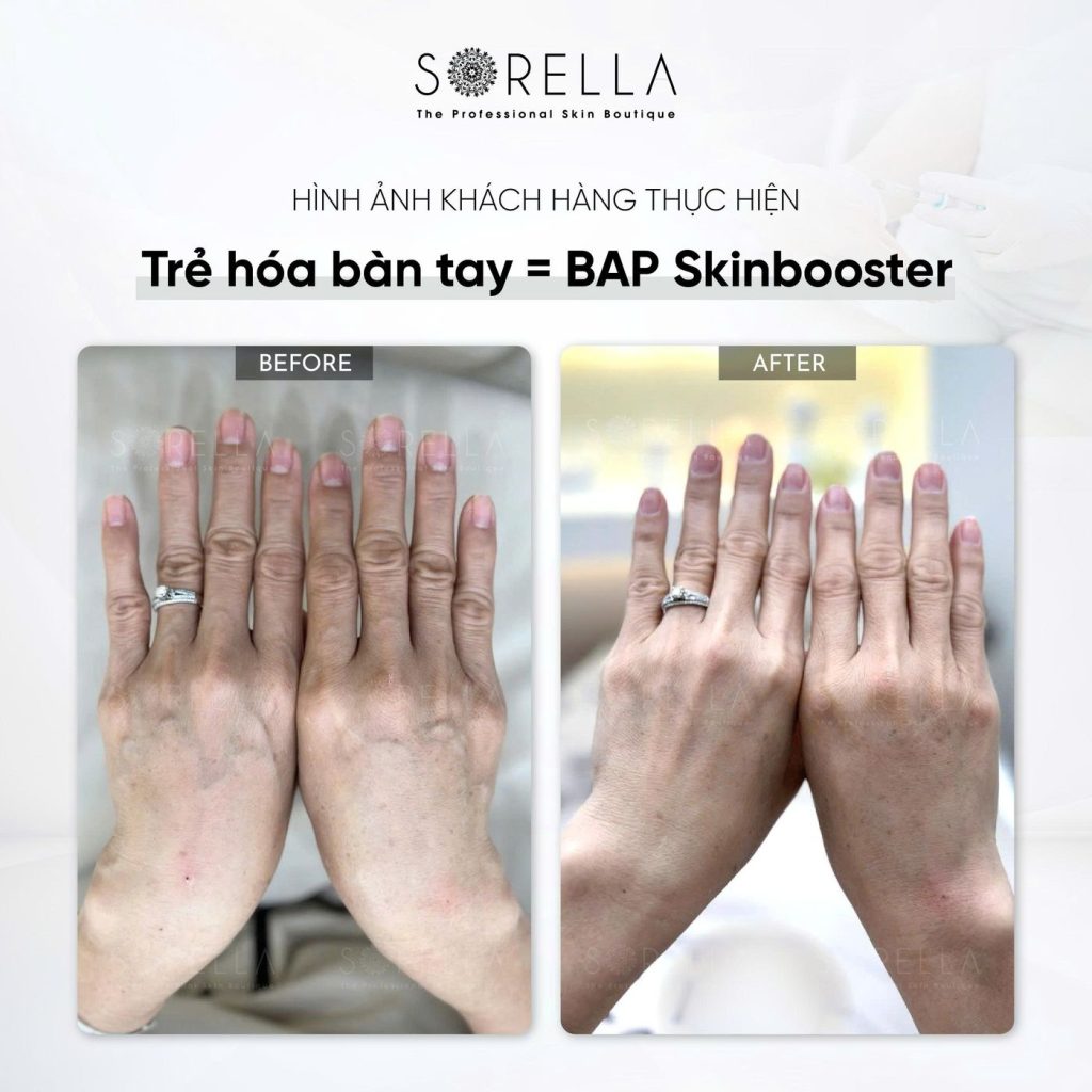 Before and after: Trẻ hoá bàn tay = BAP Skinbooster at Sorella