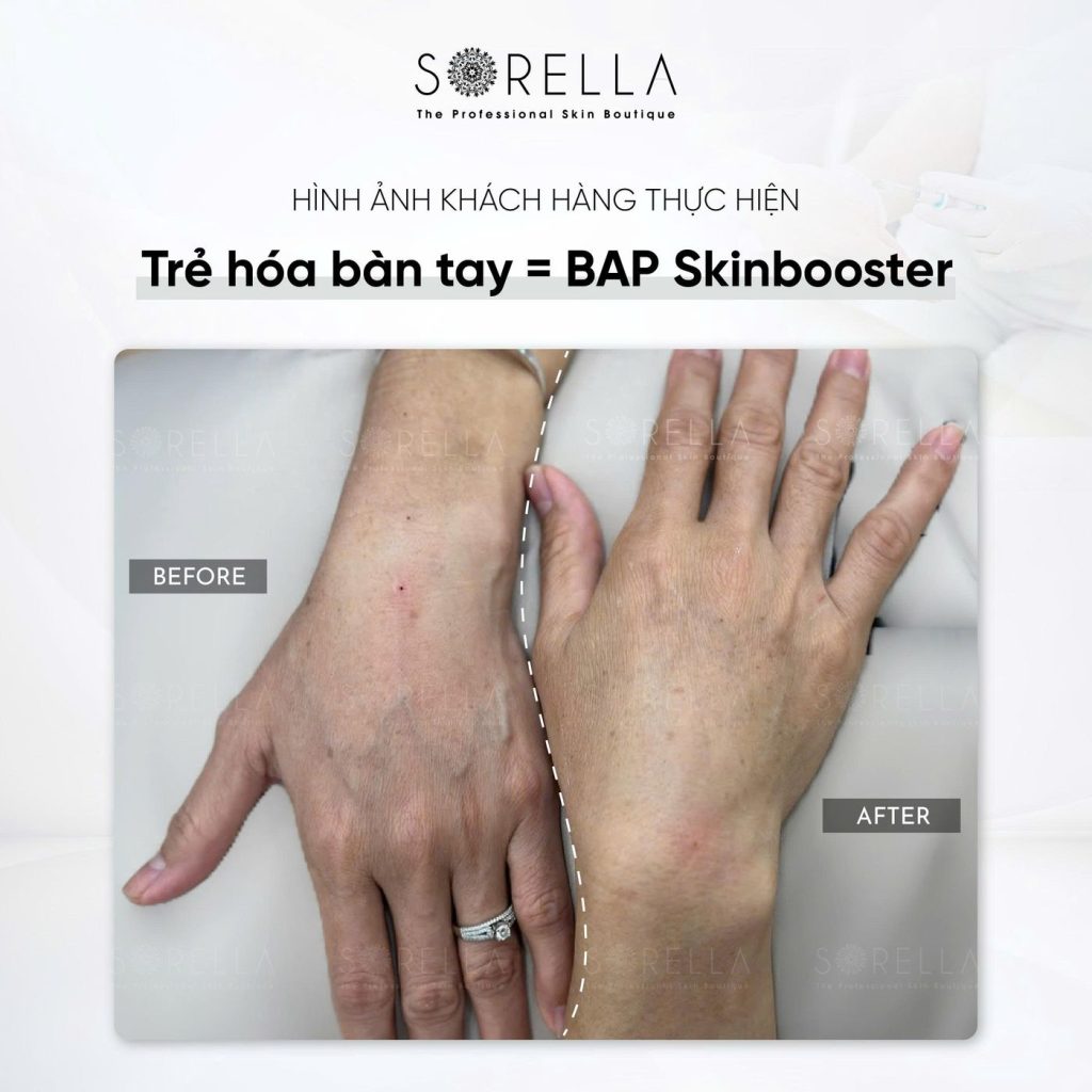 Before and after: Trẻ hoá bàn tay = BAP Skinbooster at Sorella