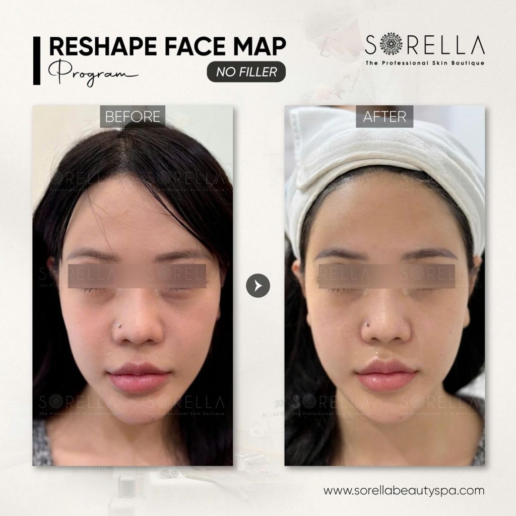 Before and after: Reshape Face Map – No Filler at Sorella