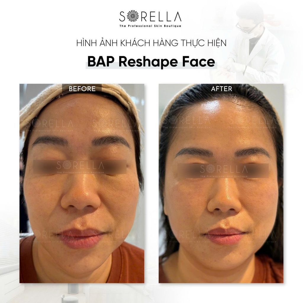 Before and after: BAP Reshape Face at Sorella