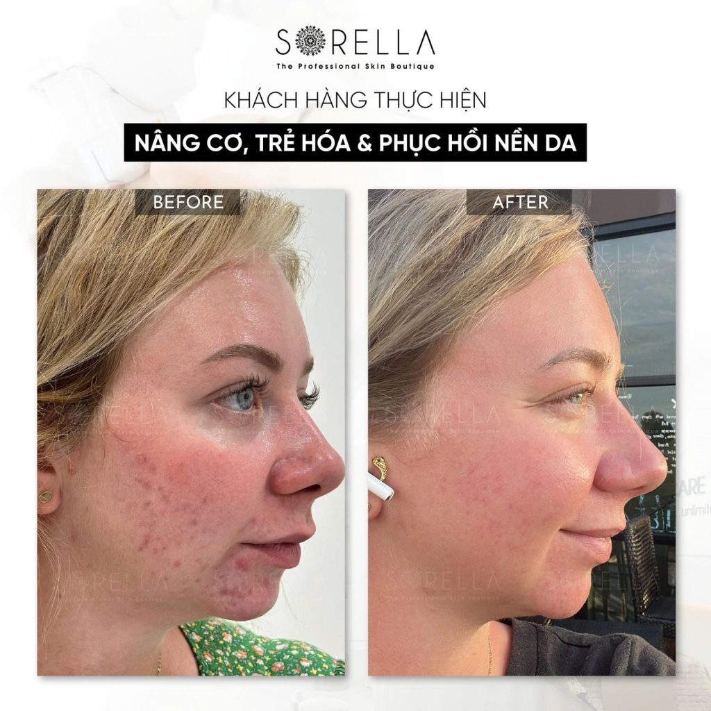 Before and after: Nâng cơ, trẻ hoá & phục hồi nền da (ca mụn) at Sorella