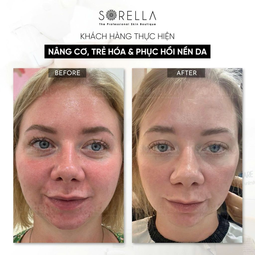Before and after: Nâng cơ, trẻ hoá & phục hồi nền da (ca mụn) at Sorella