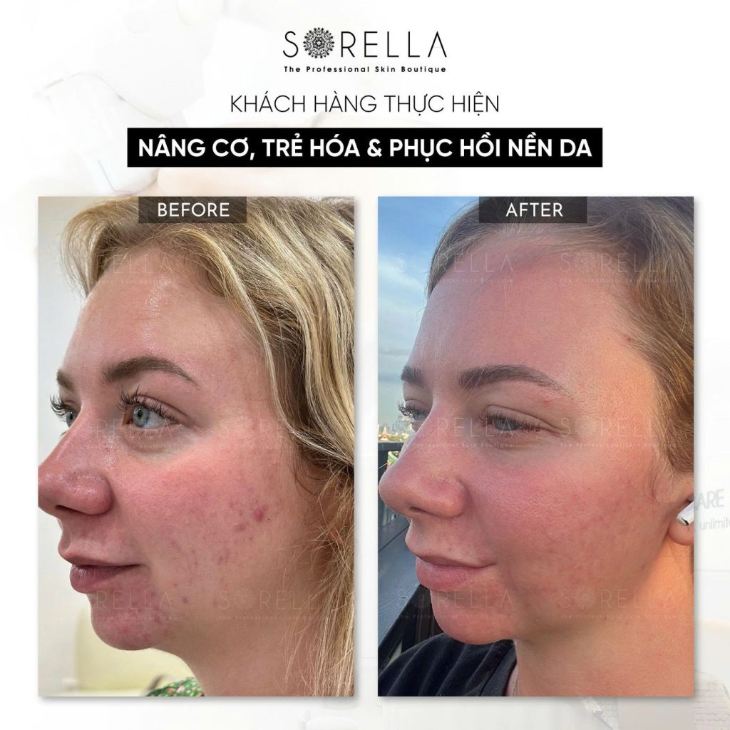 Before and after: Nâng cơ, trẻ hoá & phục hồi nền da (ca mụn) at Sorella