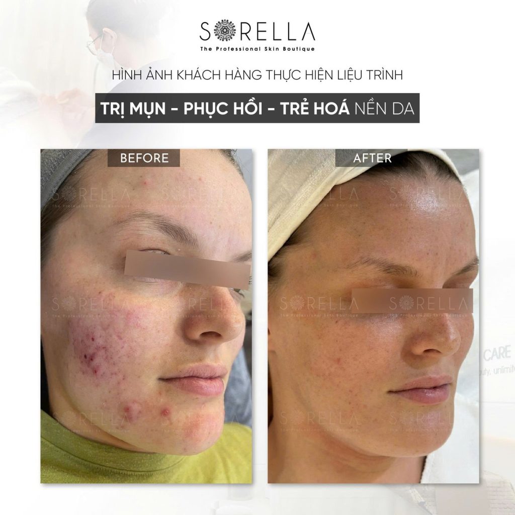 Before and after: Trị mụn – phục hồi – trẻ hoá nền da at Sorella