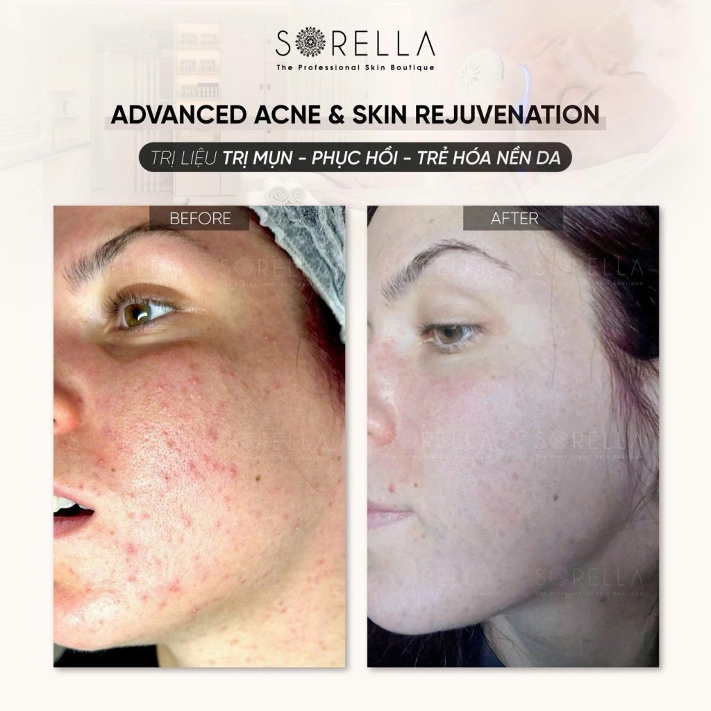 Before and after: Advanced Acne & Skin Rejuvenation at Sorella