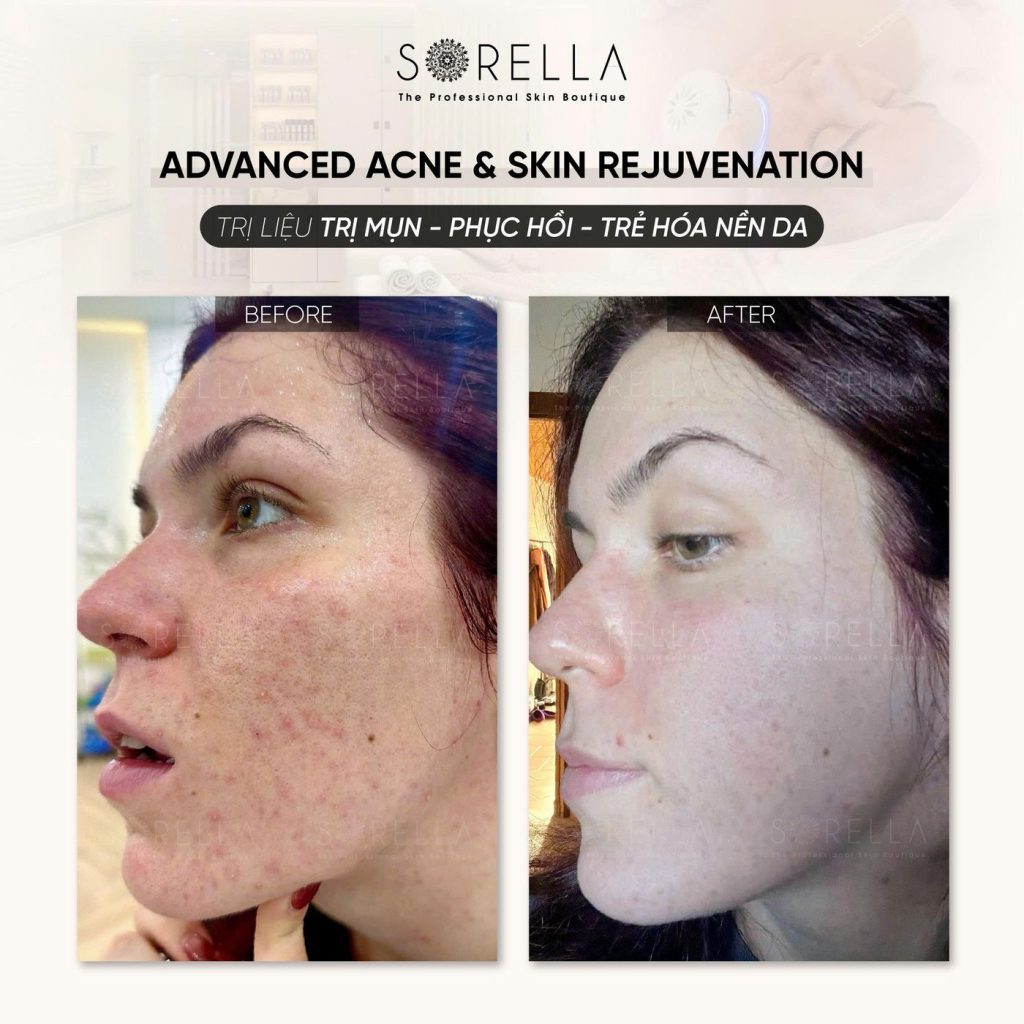 Before and after: Advanced Acne & Skin Rejuvenation at Sorella