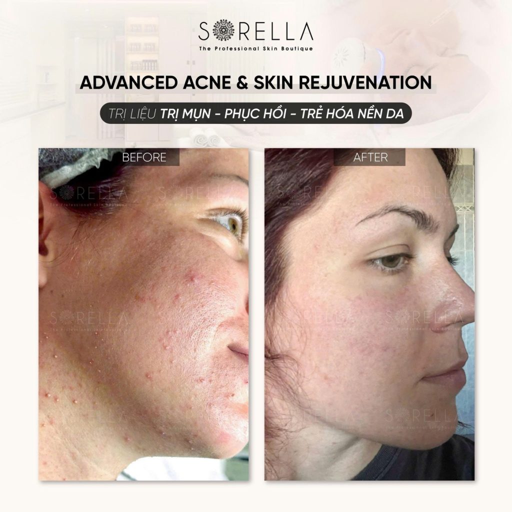 Before and after: Advanced Acne & Skin Rejuvenation at Sorella
