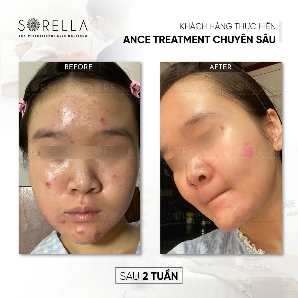 Before and after: Acne Treatment chuyên sâu at Sorella