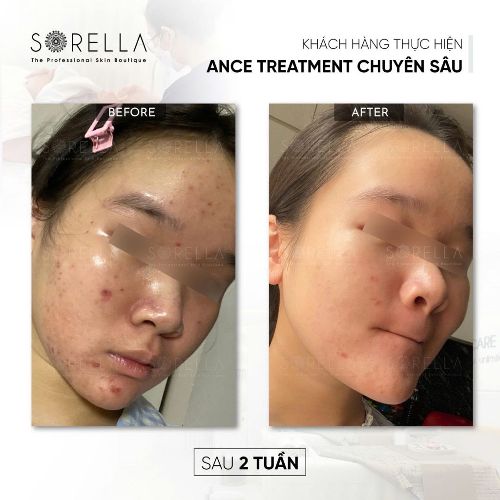 Before and after: Acne Treatment chuyên sâu at Sorella