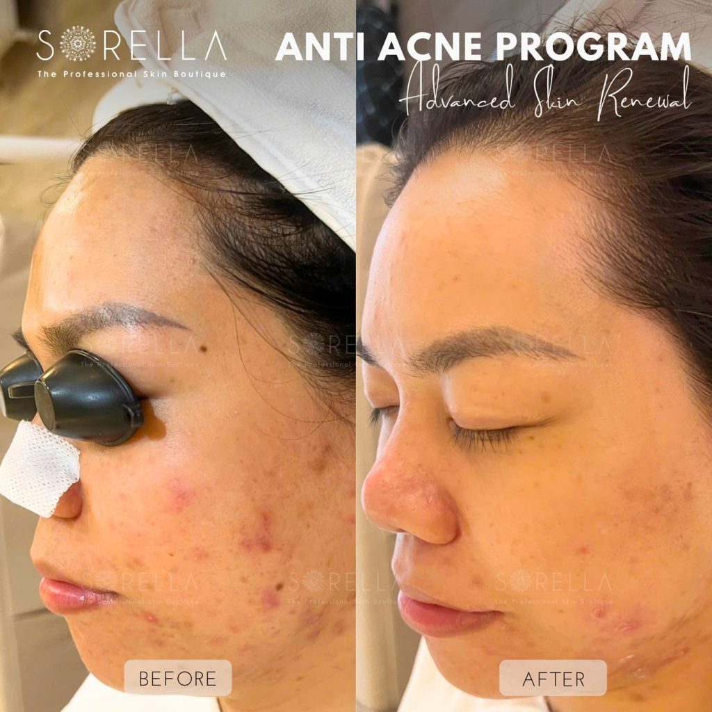 Before and after: Anti Acne Program at Sorella