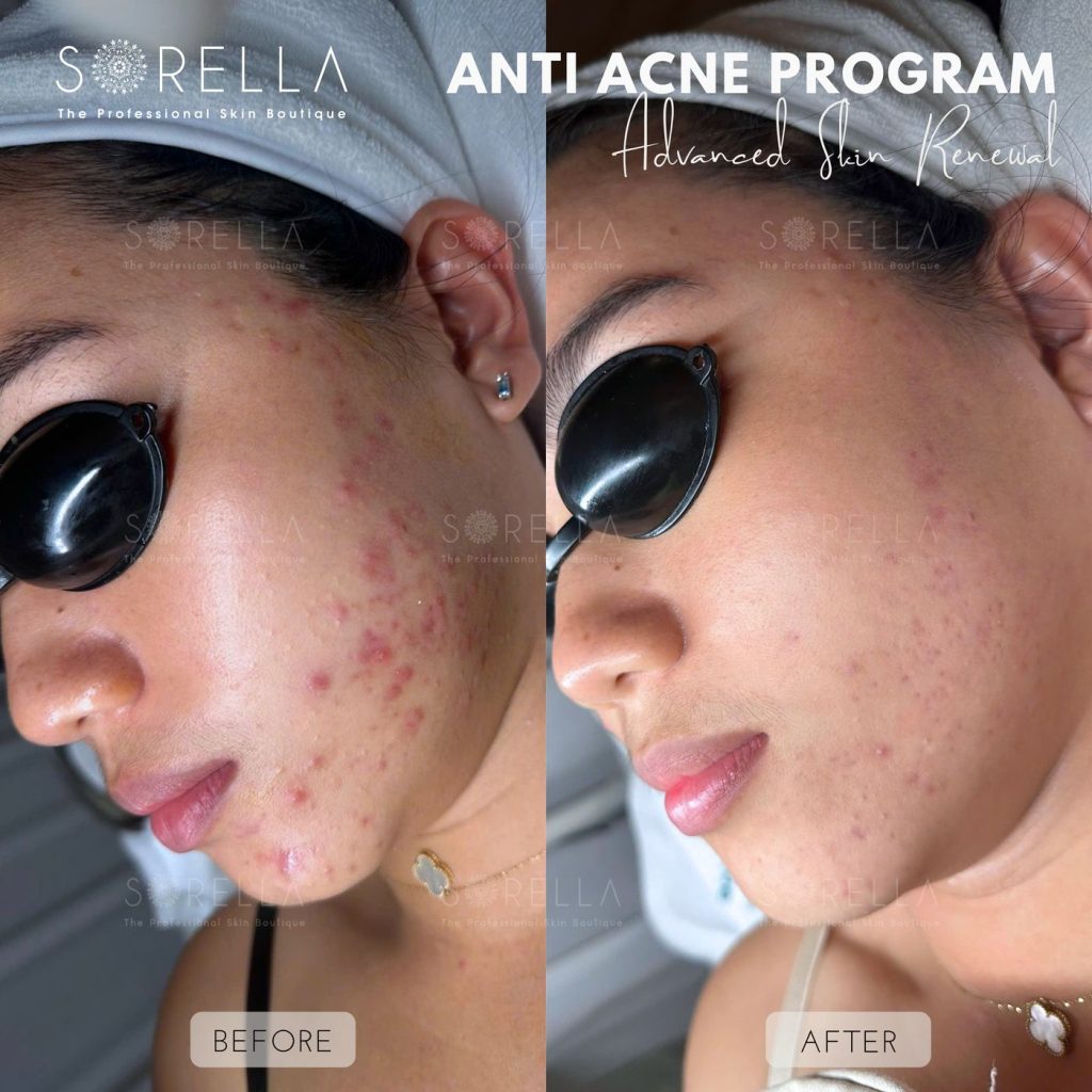 Before and after: Anti Acne Program at Sorella