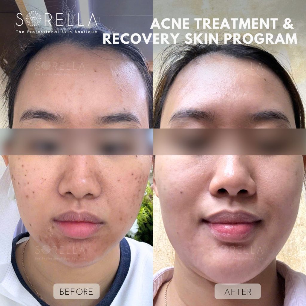 Before and after: Anti Acne Program at Sorella