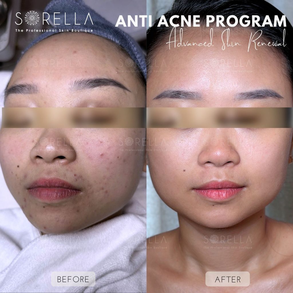 Before and after: Anti Acne Program at Sorella