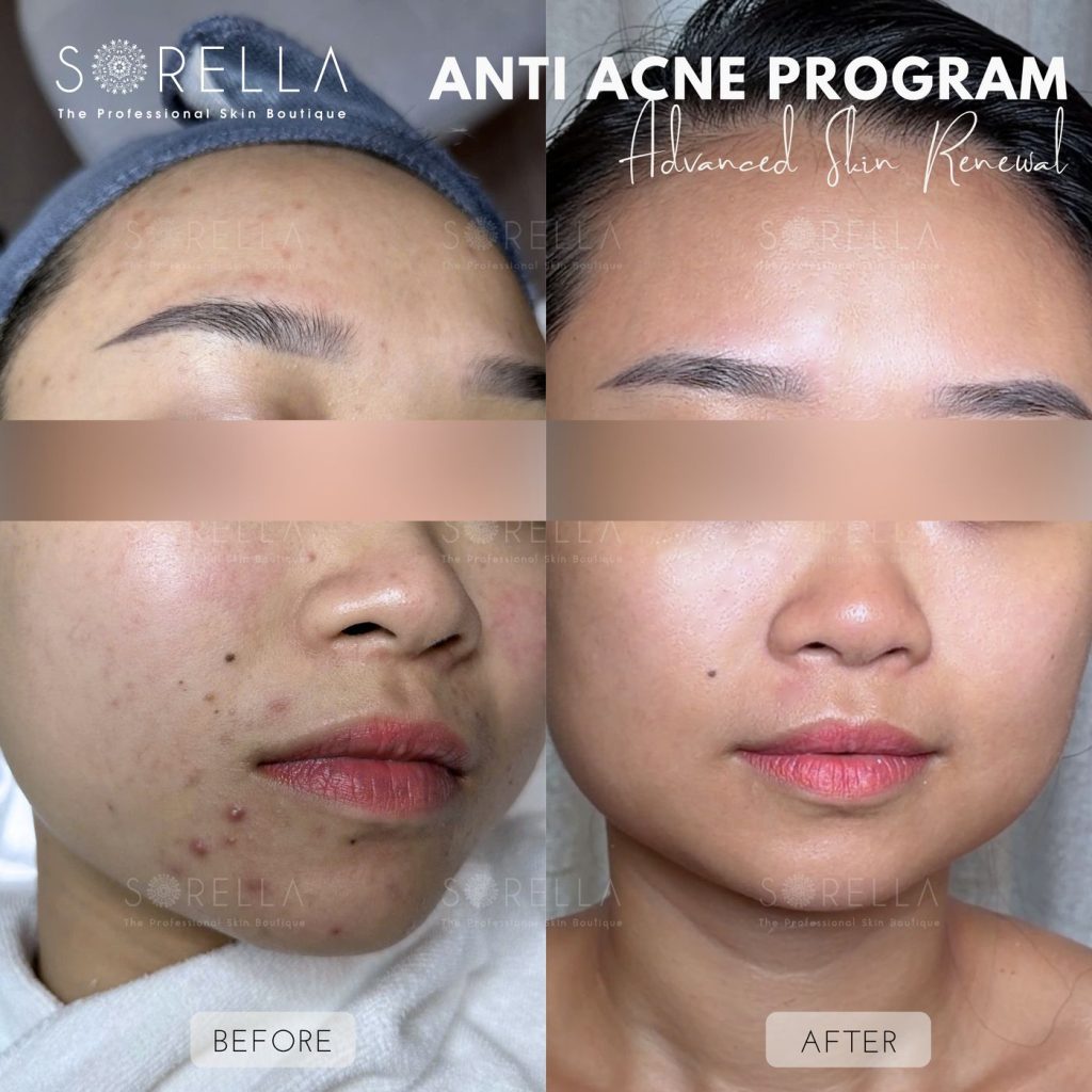Before and after: Anti Acne Program at Sorella