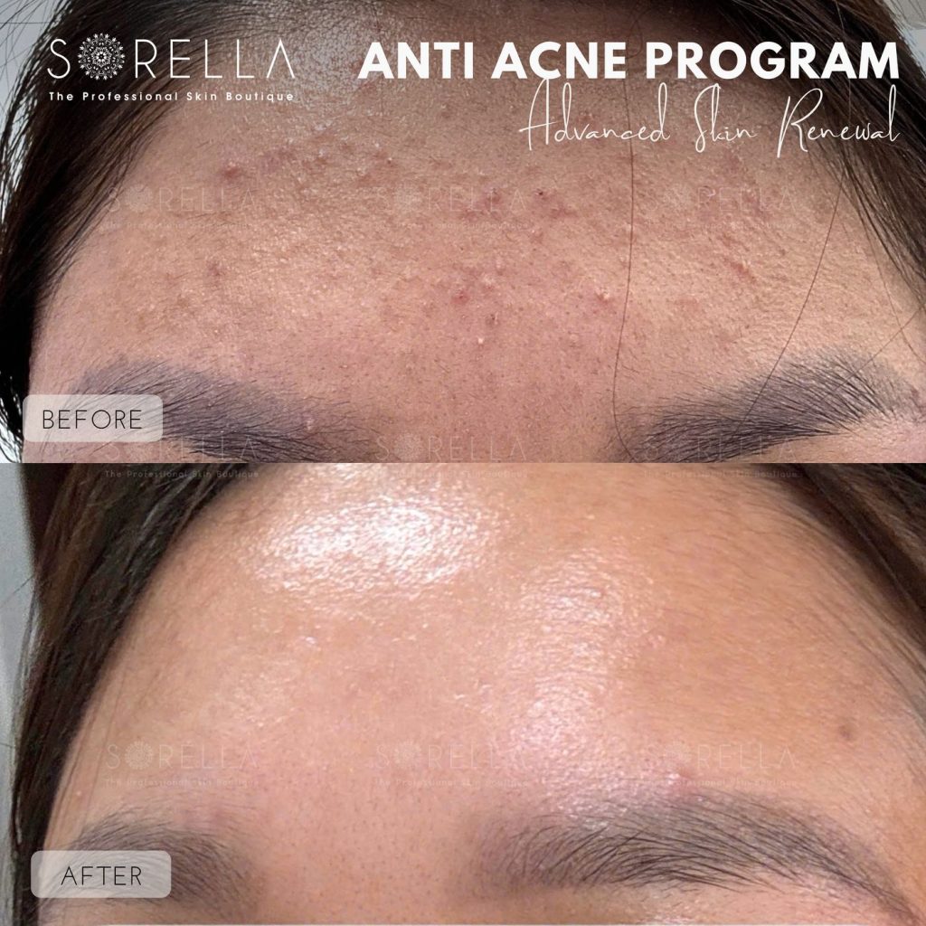 Before and after: Anti Acne Program at Sorella