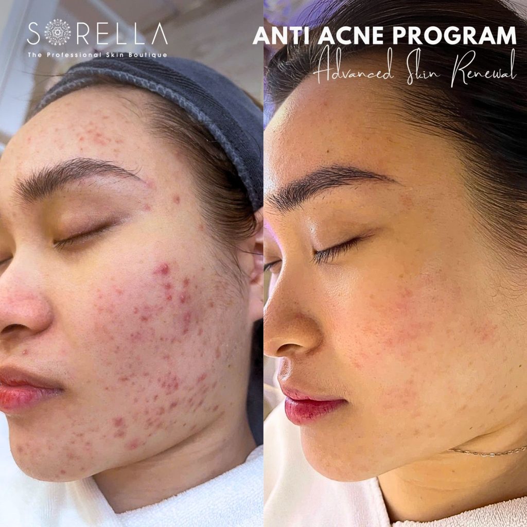 Before and after: Anti Acne Program at Sorella