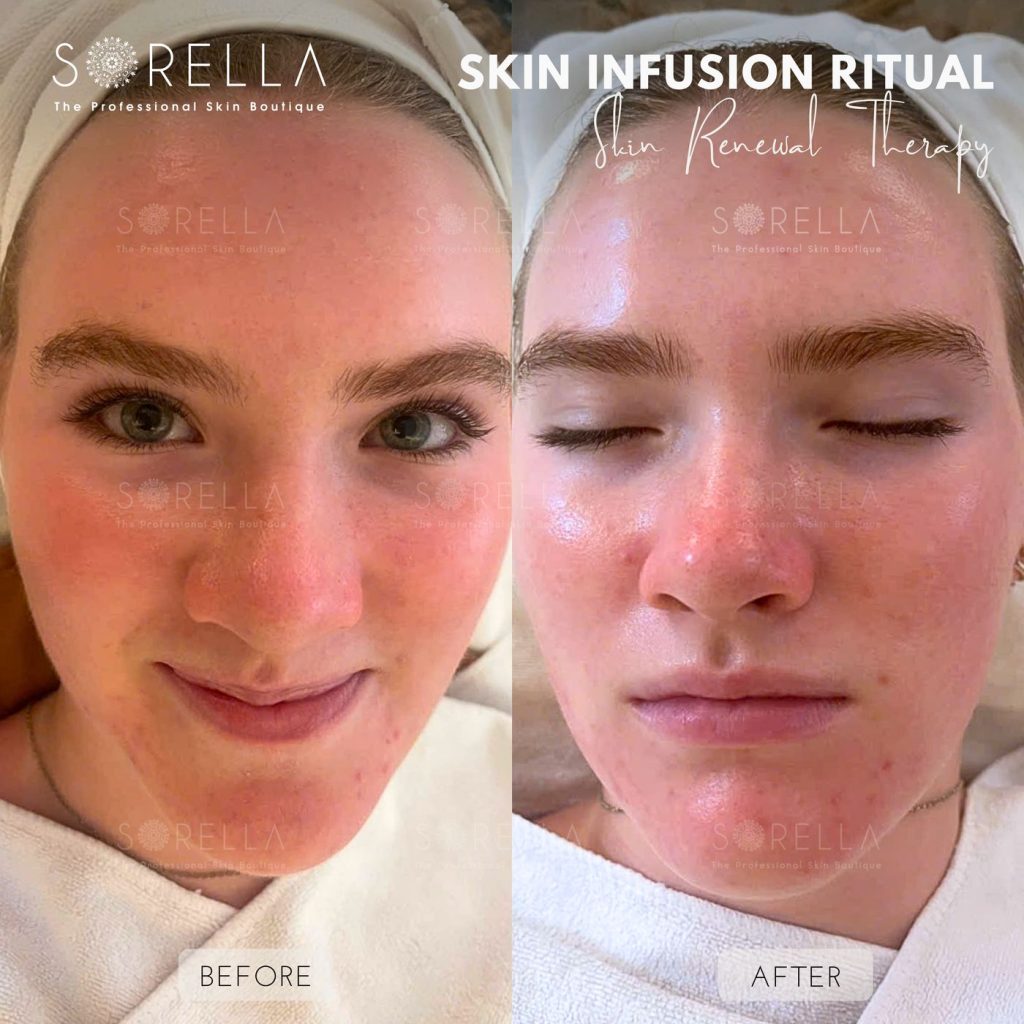 Before and after: Skin Infusion Ritual at Sorella