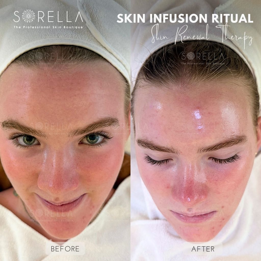 Before and after: Skin Infusion Ritual at Sorella