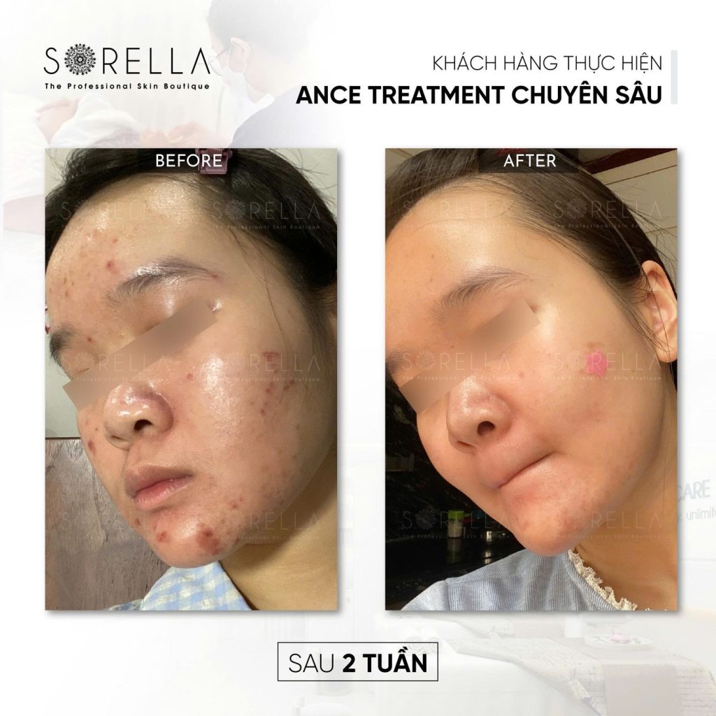 Before and after: Acne Treatment chuyên sâu at Sorella