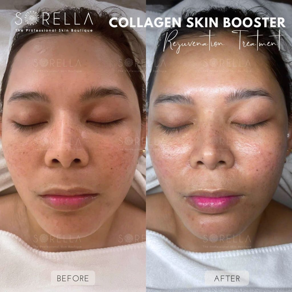 Before and after: Collagen Skin Booster at Sorella