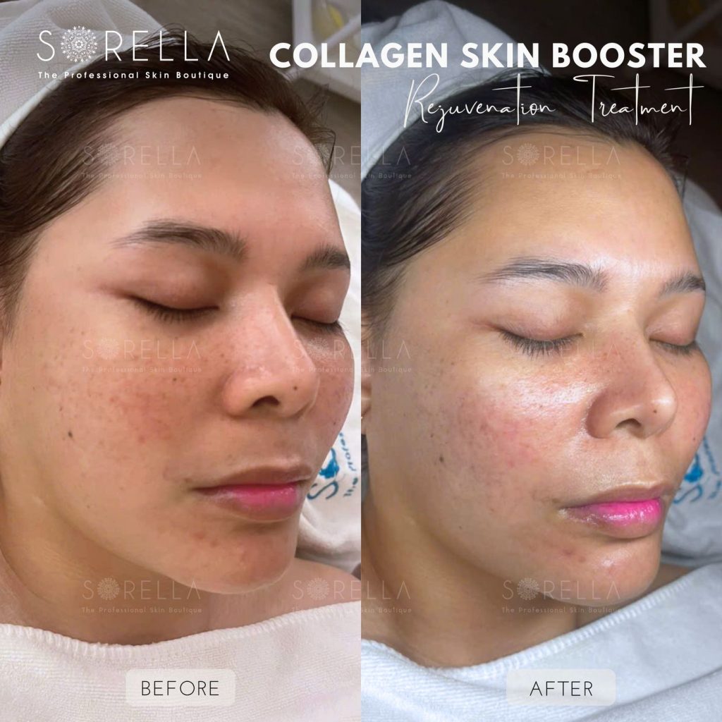Before and after: Collagen Skin Booster at Sorella