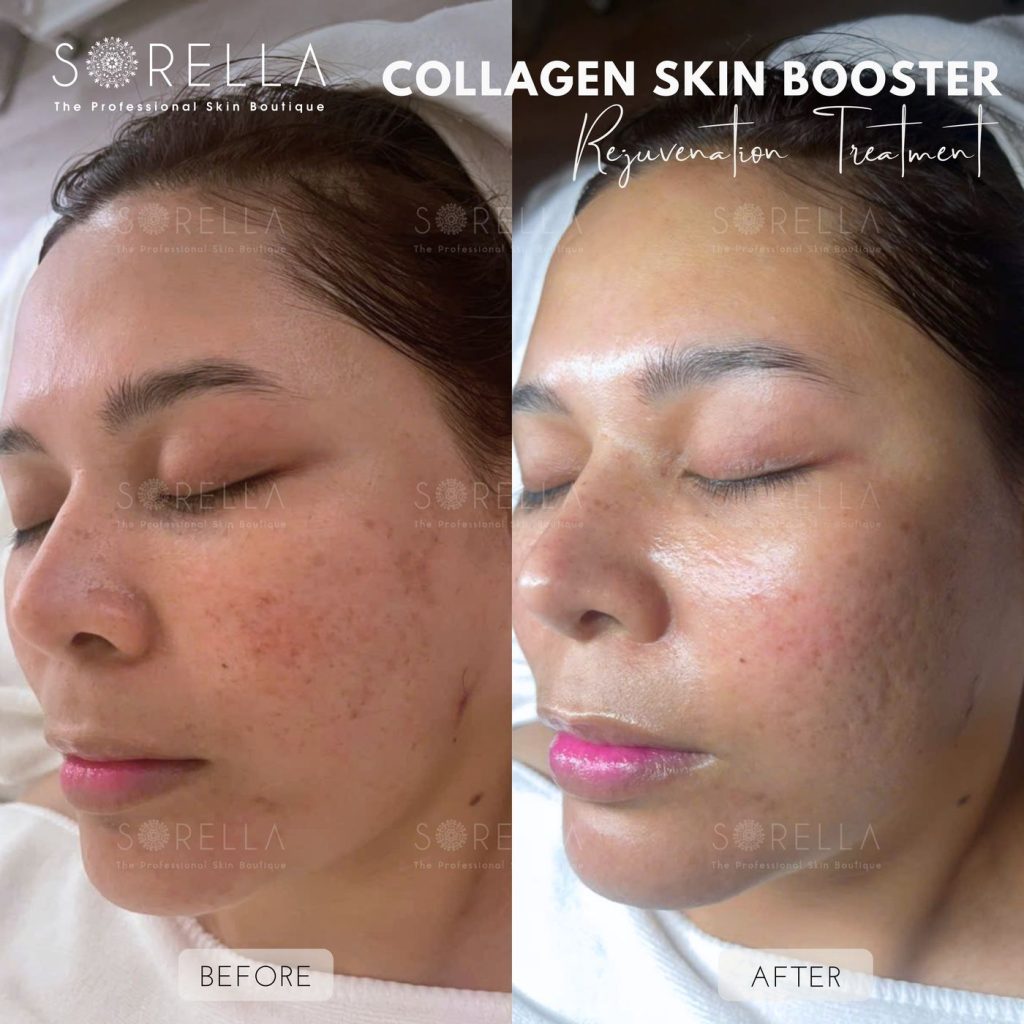 Before and after: Collagen Skin Booster at Sorella